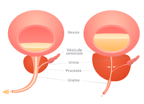 Différence entre une prostate normale et une prostate hypertrophiée